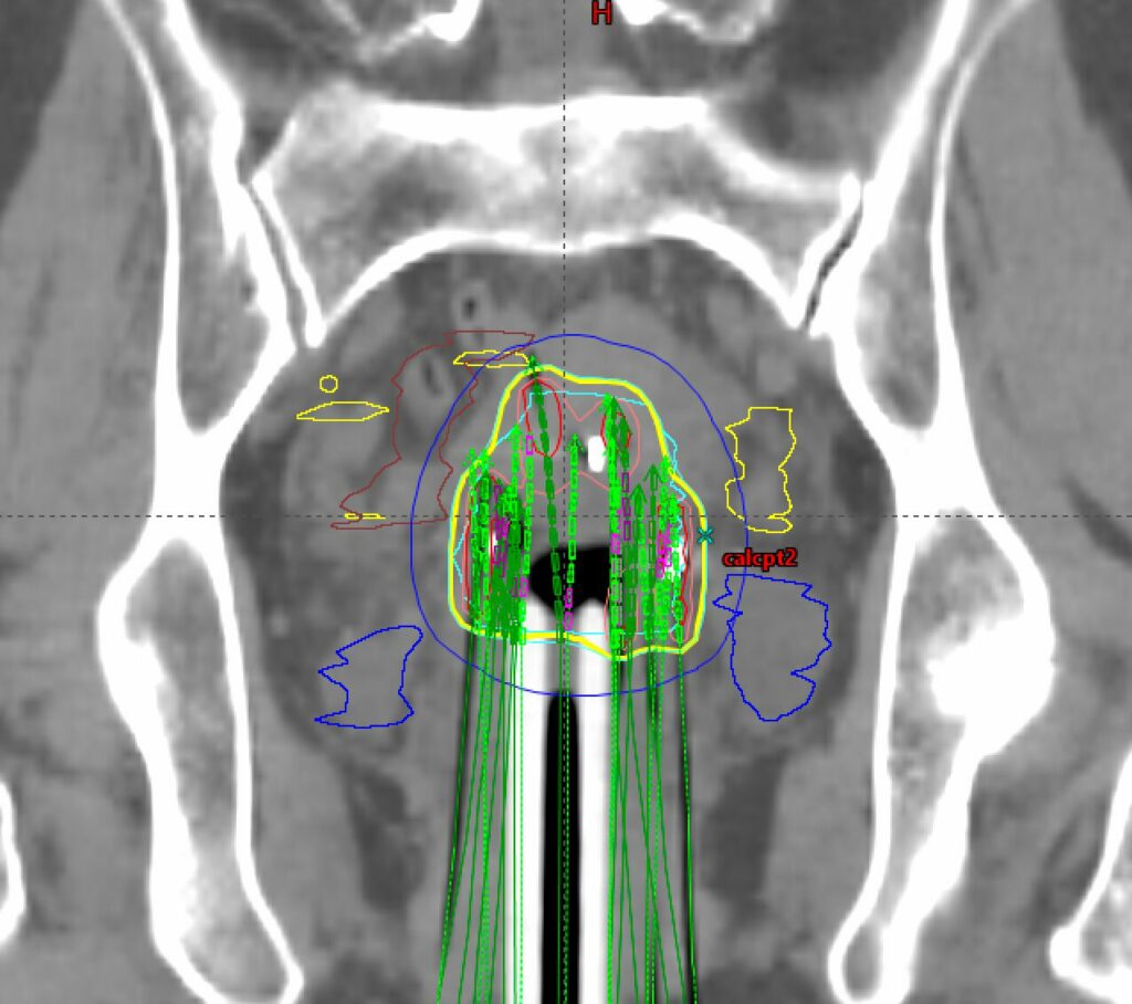 Brachytherapy - Memorial Radiation Oncology Medical Group